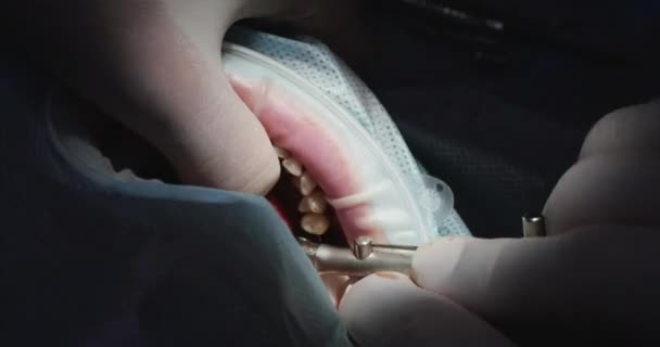 Installation von Zahnimplantaten. Zahnchirurgie — Stockvideo