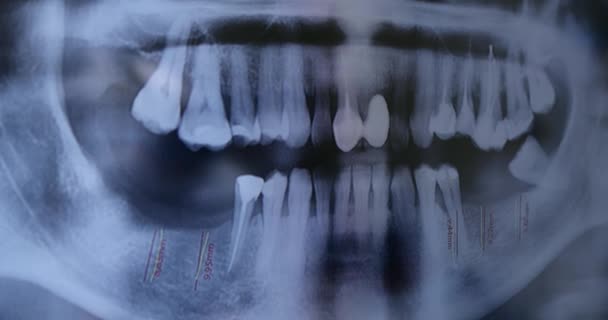 X-ray film of teeth close-up. — Wideo stockowe