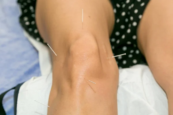 Dizinde akupunktur, dizinde iyileşme için osteoartrit tedavisi.