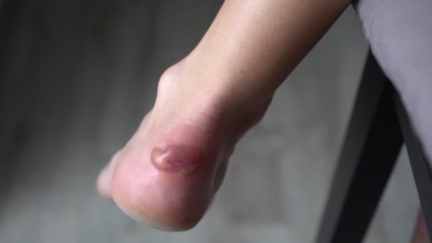 Large callus on the skin. A blistering corn on a womans leg — Stock Video