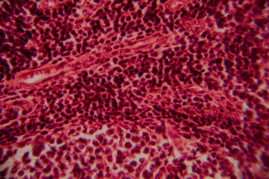 Pembe lekeli bir matris içinde yoğun paketlenmiş, koyu lekeli lenfositleri gösteren lenfoid dokusunun büyütülmüş görüntüsü..