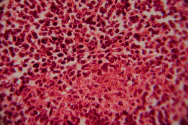 Pembe lekeli bir matris içinde yoğun paketlenmiş, koyu lekeli lenfositleri gösteren lenfoid dokusunun büyütülmüş görüntüsü..