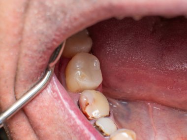 Ağır hasarlı 5. ve 6. diş, ikinci azı dişi ve birinci azı dişi, kırmızı-kahverengi diş minesi, plaka, arpacık ve eski kompozit dolguları ile yeni doldurulmuş.