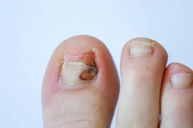 Makro çekim mantardan etkilenmiş ya da yaralı bir ayak tırnağının hafif arka planda büyük bir ayak tırnağı üzerinde olduğunu gösterir. Bu detaylı görüntü tıbbi bir sorunu, profesyonel teşhis ihtiyacını, podiatrik tedaviyi ve önemini vurguluyor.