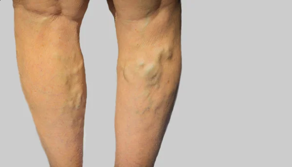 Vene varicose su gambe femminili — Foto Stock