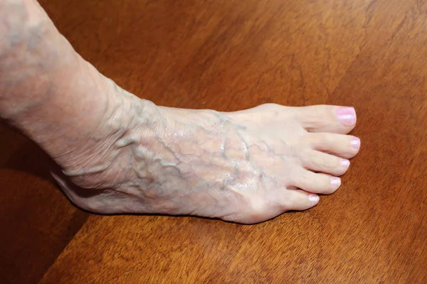 女性の老齢と病気 青い上の老婦人の足の上に静脈 多様性 クモ静脈 病気の概念 脚を手にした年上の年金受給女性 ブルースタジオの背景 — ストック写真