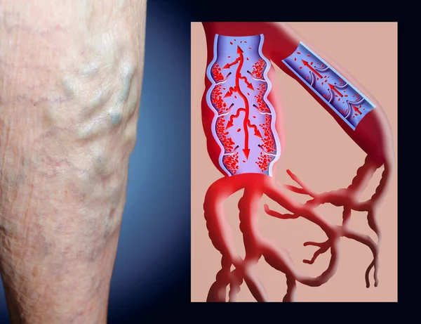 Varicose veins on a female senior legs. The structure of normal and varicose veins. Concept of dry skin, old senior people, varicose veins and deep vein thrombosis or DVT