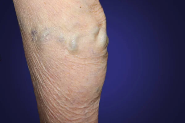 Yaşlılık Bir Kadından Bıkmak Yaşlı Bir Kadının Bacaklarındaki Varisli Damarlar — Stok fotoğraf