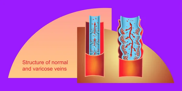 여자의 다리에 정맥류와 정맥류 정맥의 구조입니다 정맥류 혈전증 Dvt — 스톡 사진