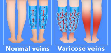 Yaşlı bir kadının bacaklarında varis damarları var. Normal ve varisli damarların yapısı. Kuru deri konsepti, yaşlı insanlar, varisli damarlar ve derin ven trombozu veya DVT. Vektör İllüstrasyonu