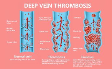 Derin damar trombozu veya kan pıhtılaşması. Emboli. Normal ve varisli kadın damarlarının yapısı. Simge Vektörü İllüstrasyonu