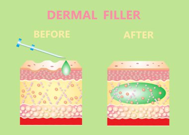 Kozmetik ya da deri dolguları. Temiz ve taze ciltli genç bir kadın. Güzel kadın. Yüz ve boyun. Dolgu konseptine göre kaldırmak. Vektör İllüstrasyonu. Öncesi ve sonrası