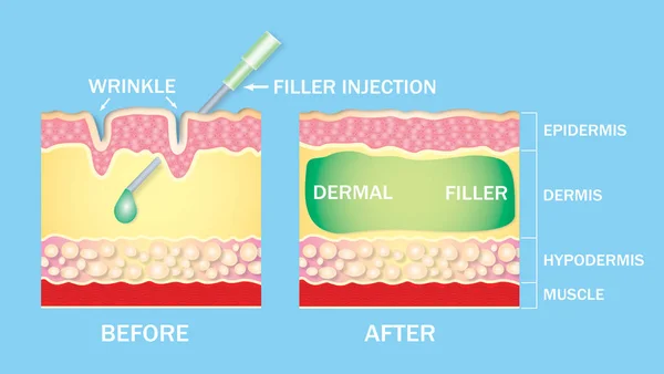 Injectable Cosmetic Filler Dermal Fillers — Stock Fotó