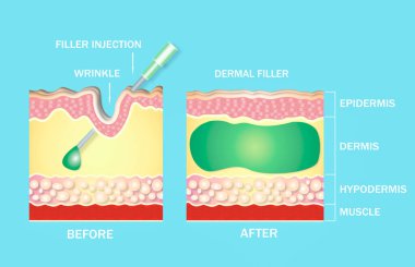 Injectable cosmetic filler or dermal fillers. Before and after. Lifting concept