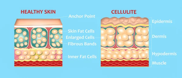Alul Bőr Cellulit Illusztráció Kialakítása Szerkezete Normális Egészséges Cellulit Bőr — Stock Fotó