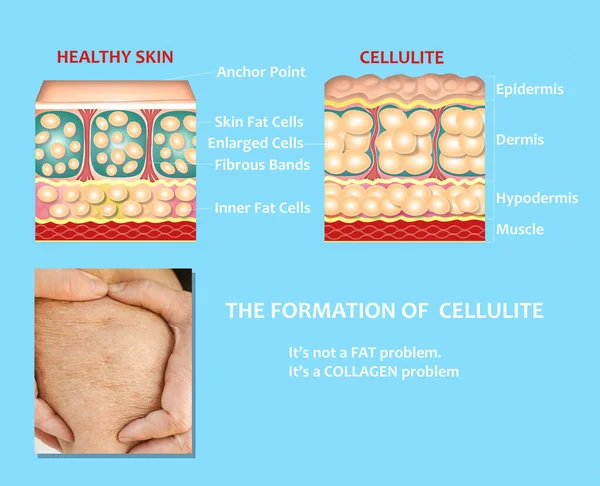 Tworzenie Podskórnej Ilustracji Cellulitu Struktura Zdrowej Cellulitowej Skóry Porównanie — Zdjęcie stockowe