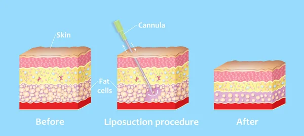 Mechanism of liposuction. Suction-assisted liposuction. Hollow tube or cannula, which is inserted through a small incision in the skin in order to fat suctioned out of the body