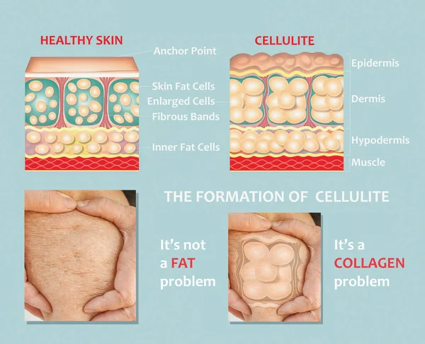 Tvorba Podkožní Celulitidy Ilustrace Struktura Normální Zdravé Celulitidy Kůže Porovnání — Stock fotografie