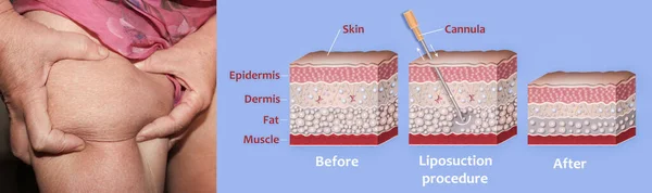 Mechanismus Der Fettabsaugung Saugunterstützte Fettabsaugung Hohlrohr Oder Kanüle Die Durch — Stockfoto