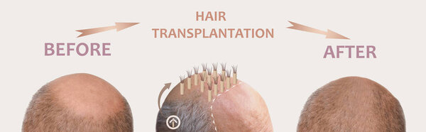 Methods of hair transplantation FUT and FUE fue with transplant as infographic element of illustration. Human alopecia or hair loss problem on adult senior or mature man. Before and after concept