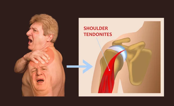 Schultergelenksstruktur Und Schultersehnenentzündung Die Collage Eines Älteren Mannes Mit Schulterschmerzen — Stockfoto