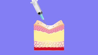Injectable cosmetic filler or dermal fillers. Before and after. Lifting concept