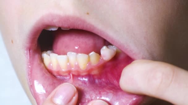 Makro chwiejnego zęba niemowlęcego w jamie ustnej dziecka — Wideo stockowe