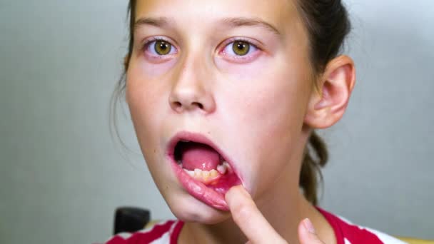 Girl opening mouth and pushing shaky baby tooth with tongue — Stock Video