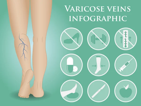 Infográficos vetoriais de flebologia —  Vetores de Stock