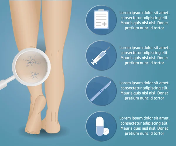 Phlebologie-Vektor-Infografiken — Stockvektor