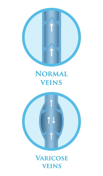 Vene varicose vettoriali — Vettoriale Stock