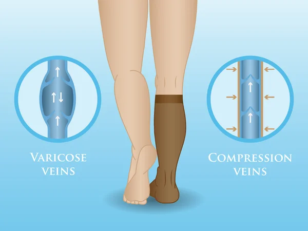 Calze a compressione medica — Vettoriale Stock