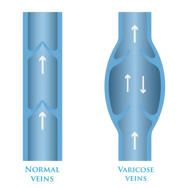 Vectores varicosas — Vector de stock