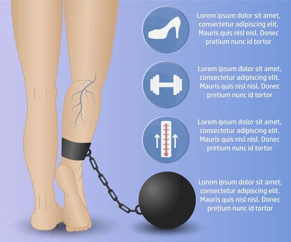 Åderbråck Infographics phlebology — Stock vektor