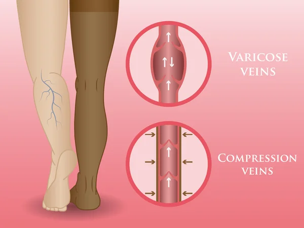 Medische compressie kousen — Stockvector