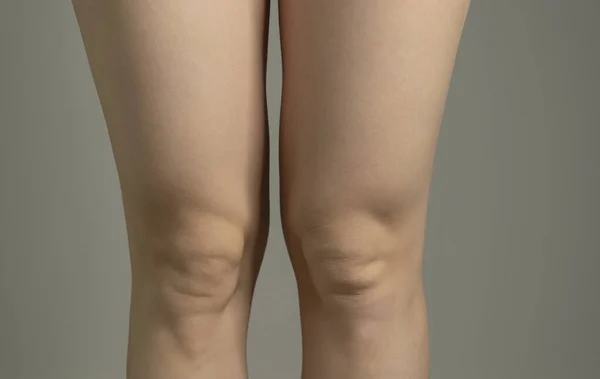 Sobrepeso Grasa Por Encima Las Rodillas Mujer Figura Grasa Delgada —  Fotos de Stock