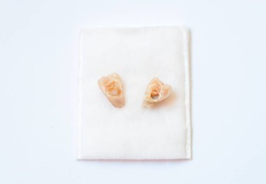 Klinikte dişçiye gittikten sonra çocuk ağzından çıkan kırık süt dişi, çürük dişler ikiye bölünmüş.