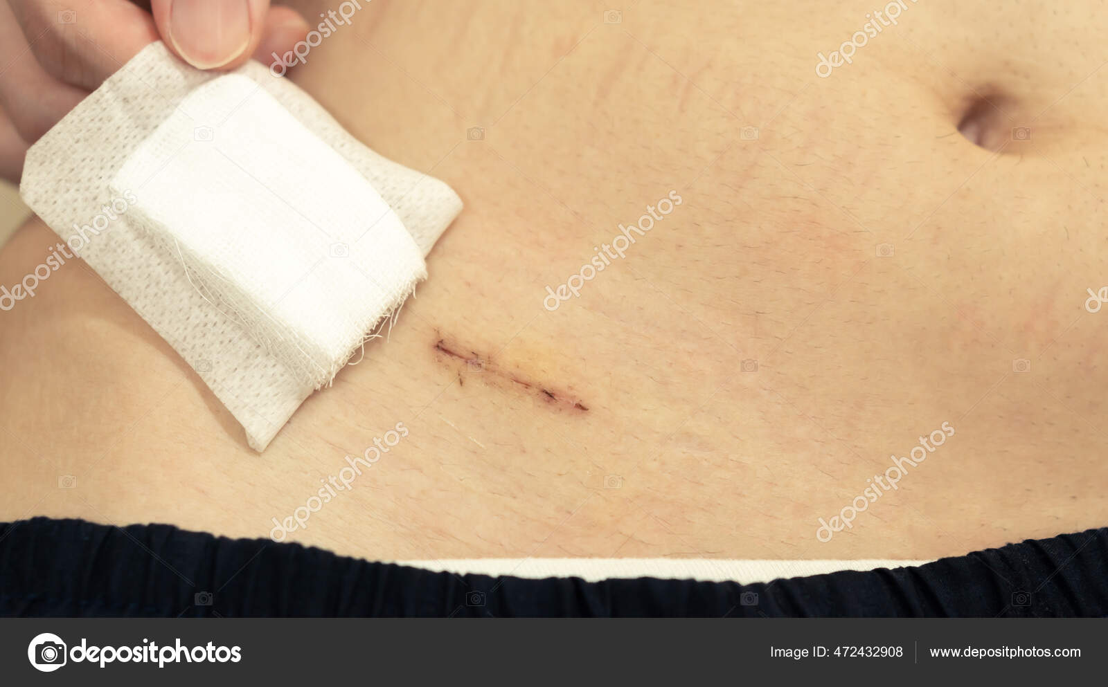 Male Teen Hand Removing Patch Showing Fresh Appendix Surgical Wound Stock Photo by ©Black_Kira
