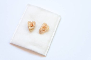 Klinikte dişçiye gittikten sonra çocuk ağzından çıkan kırık süt dişi, çürük dişler ikiye bölünmüş.