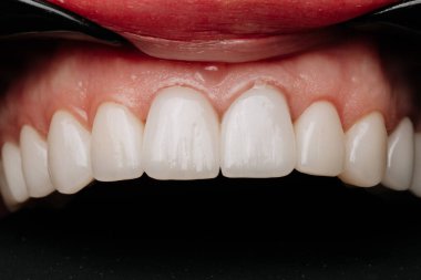 Siyah arka planda sağlıklı pembe diş etleri olan üst porselen kaplamaların makro yakın çekimi. Yüksek kalite fotoğraf