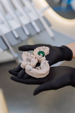 Diş kliniğinde eldivenli eldiven giymiş ortodontik damak genişletici modeller, yakın plan. Yüksek kalite fotoğraf
