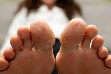 Ön manzara iki ayak tabanını ve ayak parmaklarındaki sertleşmiş deriyi gösteriyor. Geniş açılı tıbbi fotoğraf ayak ve kuru deriyi sembolize ediyor..