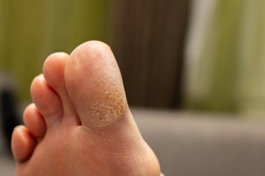 Ayak parmağındaki pullu ve kalınlaşmış deri tabakasının yakından görüntüsü. Deri hastalıkları, egzama veya nasır tedavisine uygun yüksek kaliteli görüntü.