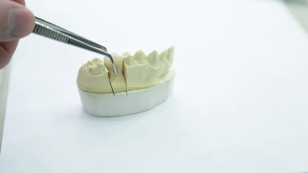 Inspekce umělých koruny na obvod krku zubu, closeup. — Stock video