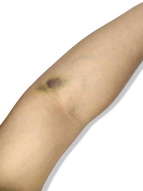 Dirseğin yanında belirgin, koyu renk bir çürük (hematom) gösteren bir insan kolu, genellikle bir kan alma (venipunktur) ya da beyaz arka planda izole edilmiş bir enjeksiyondan kaynaklanır. Sağlık hizmetleri makaleleri