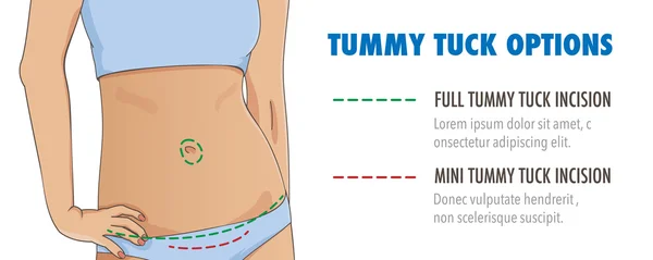 Tummy tuck, abdominoplasty infographic banner — Stock Vector