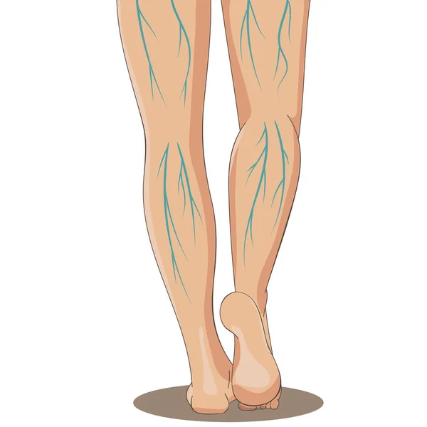 Varicosity Patas Femeninas Vista Trasera Con Venas Varicosas Ilustración Vectorial — Vector de stock