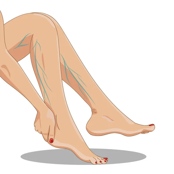 Варикозність Втомлені Жіночі Ноги Сидять Вид Збоку Вітряними Венами Одна — стоковий вектор