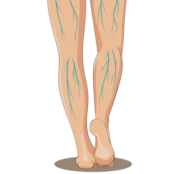 Варикантность Женские Ноги Вид Сзади Варикозное Расширение Вен Векторная Иллюстрация Лицензионные Стоковые Иллюстрации