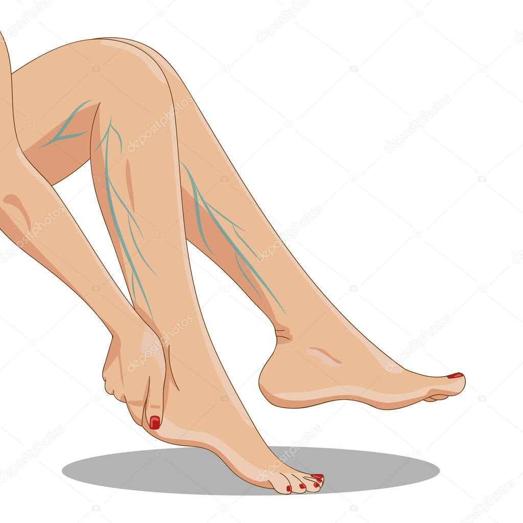 Varicosity. Tired female legs sitting, side view, with varicose veins, one hand above the ankle. Vector illustration for medicine or cosmetology infographic and design. Cartoon style.